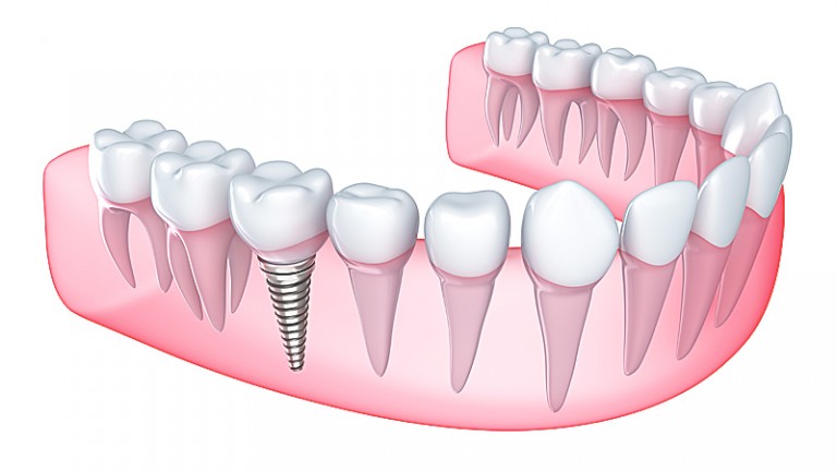 implante clinica dental tudela