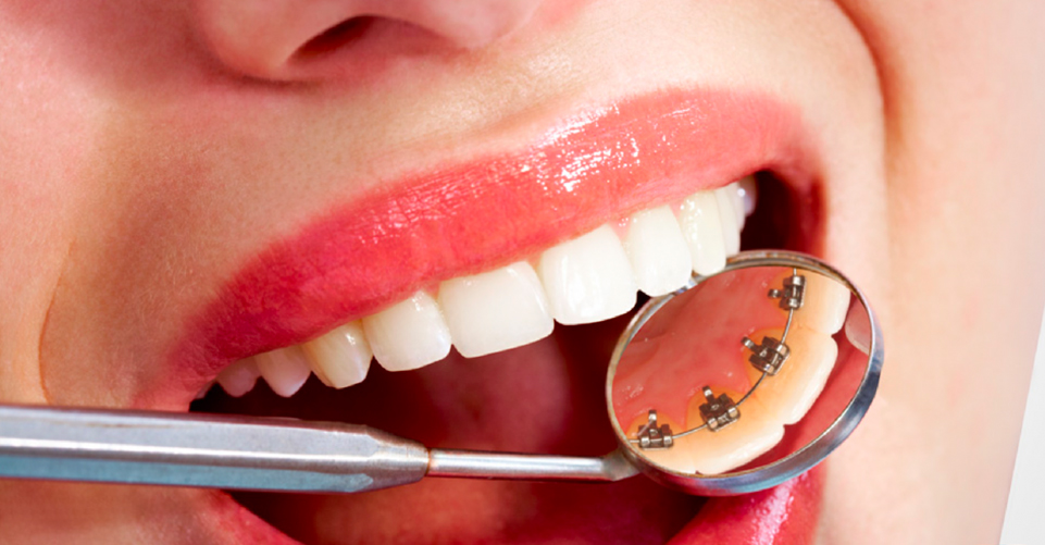 ortodoncia lingual mockup dental tudela