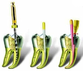 Endodoncia rotatoria mecanizada mockup dental
