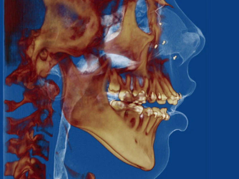 Cirugía Ortognática con Ortodoncia