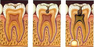 endodoncia rotatoria mecanizada