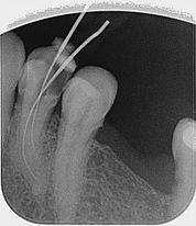 tratamiento endodoncia clinica dental en tudela