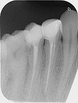 tratamiento endodoncia clinica dental en tudela