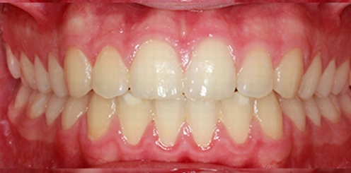 blanqueamiento casos reales clínica Mockup dental