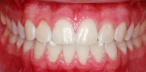 blanqueamiento casos reales clínica Mockup dental