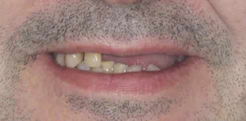 Implantes dentales en Tudela Mockup Dental