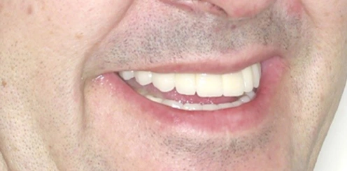 Implantes dentales en Tudela Mockup Dental