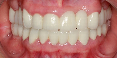 Implantes dentales con Corona en Tudela Mockup Dental