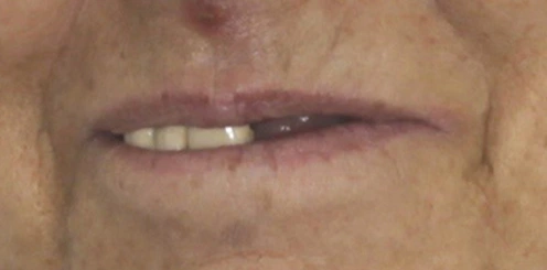Implantes dentales con Corona en Tudela Mockup Dental
