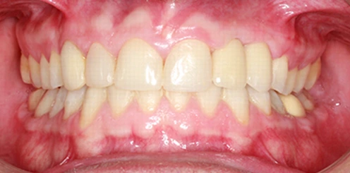 Ortodoncia e Implantes Dentales Mockup dental en Tudela