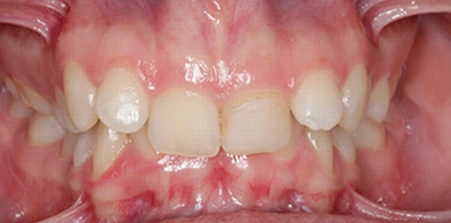 Ortodoncia Mockup dental en Tudela