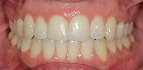 Ortodoncia Mockup dental en Tudela